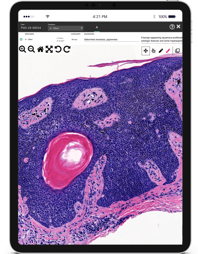 ipad_1 Skin biopsy sample on tablet