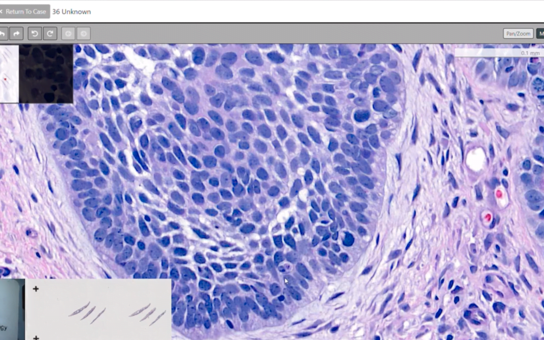 Basal Cell Carcinoma and dermatopathology