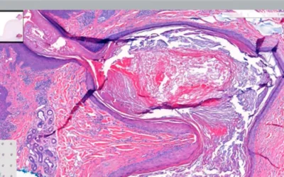 Can You Identify an Epidermal Inclusion Cyst?