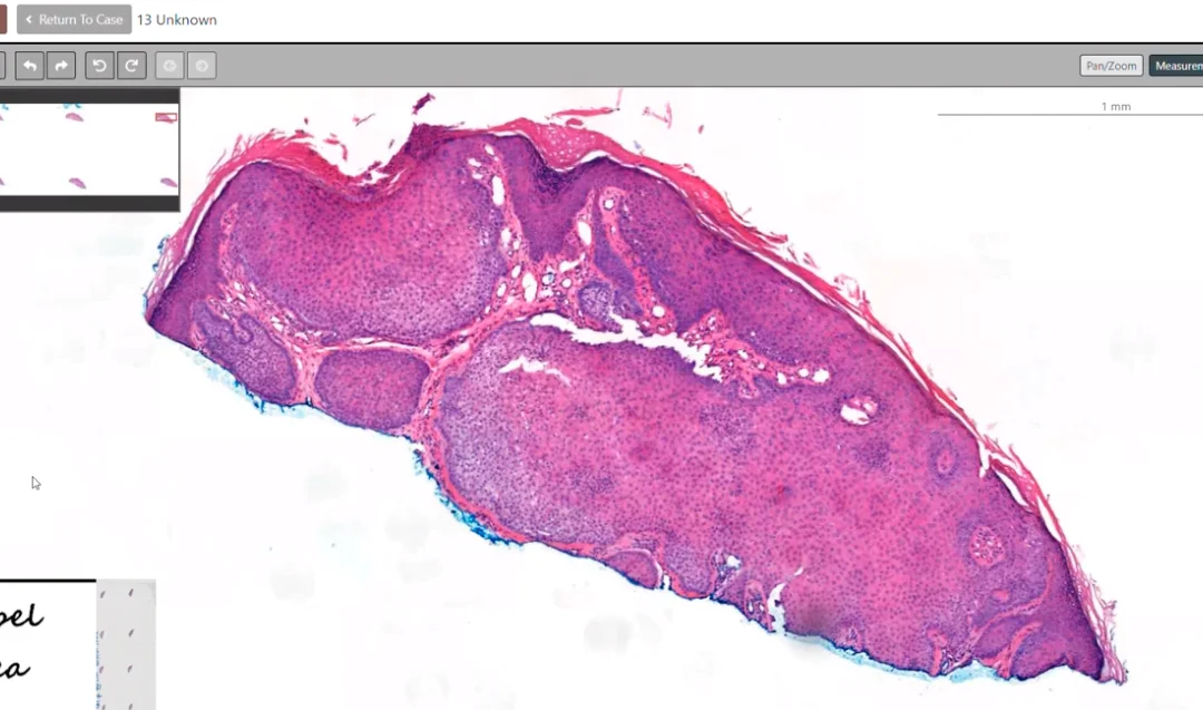 Hair Follicle Tumors