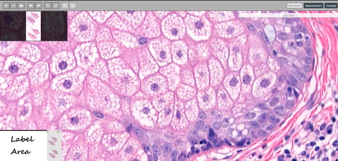 Sebaceous Neoplasms PathologyWatch