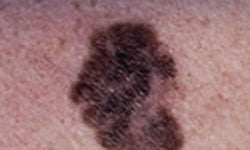 melanoma mark image